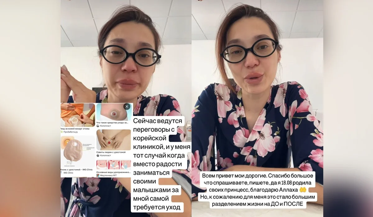 Ақтөбе дәрігерлері егіз қыз босанған келіншектің жатыры мен қуығын бірге тігіп жіберген