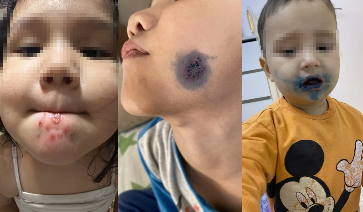 Ата-аналар алаңдаулы: балалардың беті мен денесіне біртүрлі жара шығып жатыр