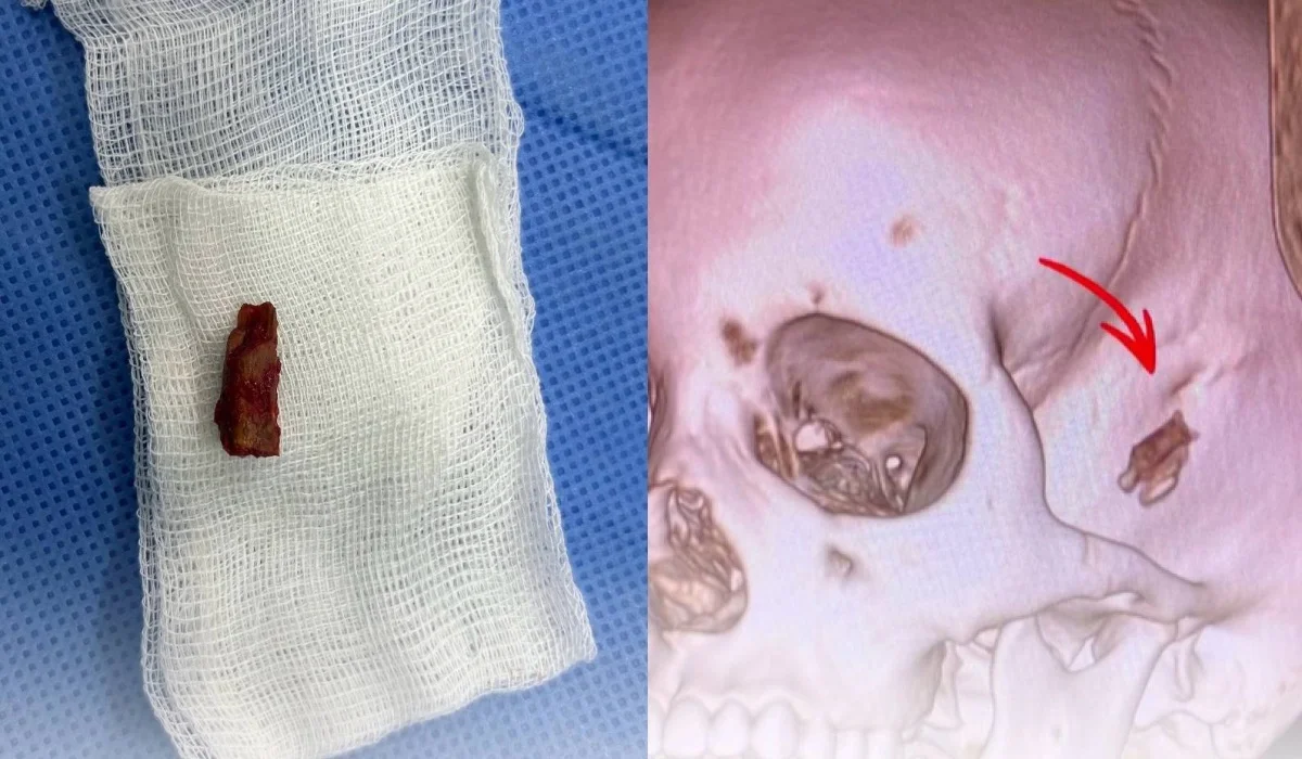 Павлодарда бүлдіршіннің басына күрделі ота жасалып, бес жыл бойы тұрған ағаш шығарылды