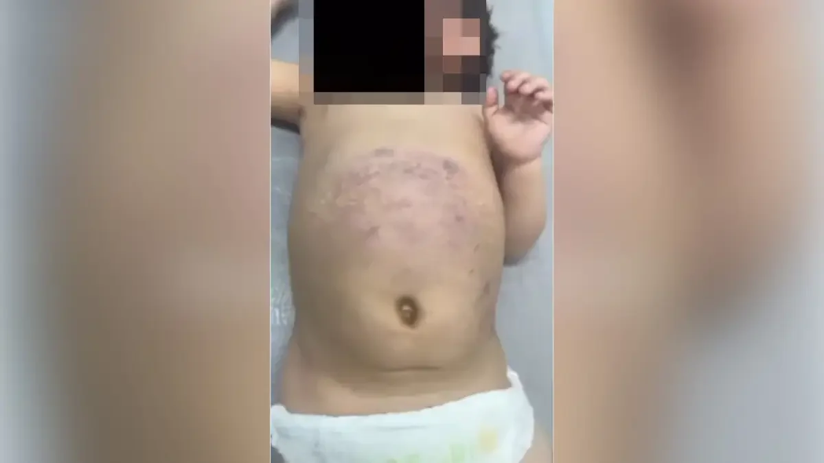 Жетісуда әкесі аяусыз ұрған үш жасар бүлдіршін хирургиялық бөлімде жатыр