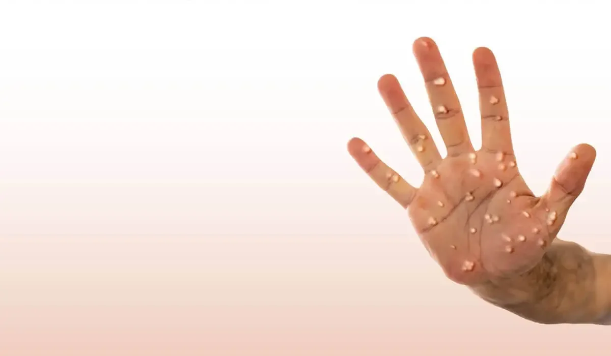 Ресейде Тайландта демалып келген екі адамнан маймыл шешегі анықталды