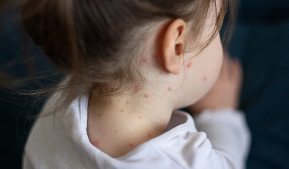 Қазақстанда қызылшаға қарсы екпе алмаған балалар мектеп пен балабақшаға уақытша кіре алмайтын болды