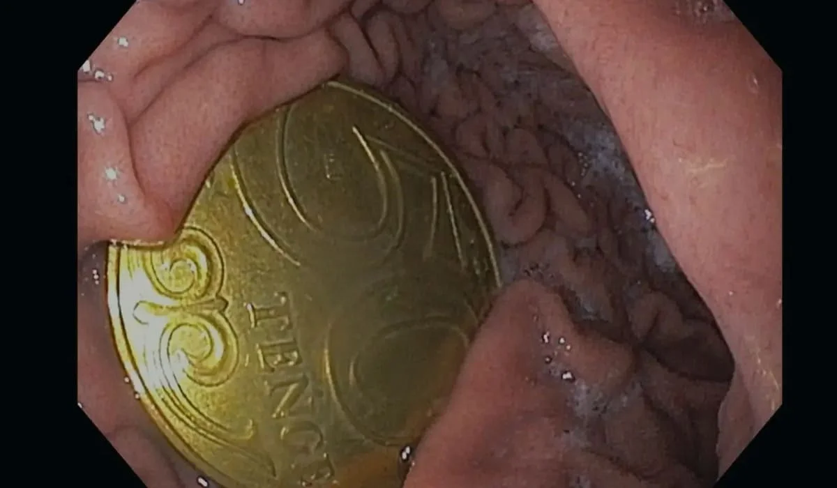 «Ата-анасы өзі түсіп қалады деп ойлаған»: Ақтауда бес жасар бала 50 теңгелік тиынды жұтып алып, үш күн жүрген (ФОТО)