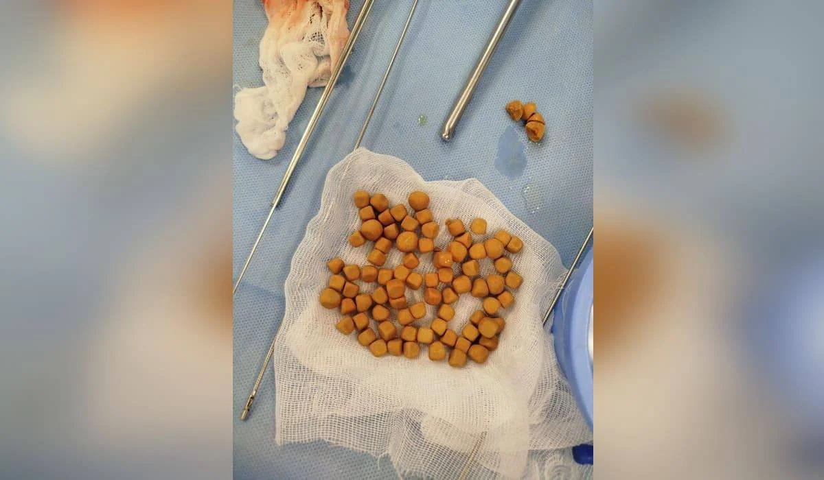 Түркістанда 61 жастағы тұрғынның қуығынан 80 тас шыққан (ФОТО)