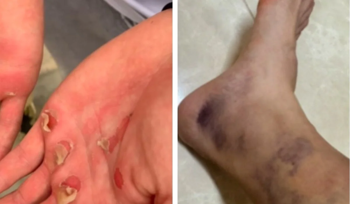 Қол-аяғы көгеріп, әбден қиналған: Дубайда жарысқа қатысқан қазақ қызы қандай қиындықтан өткенін көрсетті (ВИДЕО)