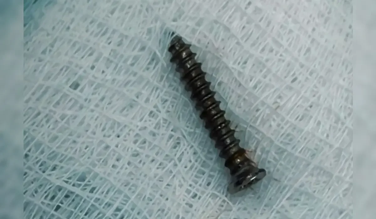 Павлодарда дәрігерлер кішкентай баланың асқазанынан бұранда алып шықты