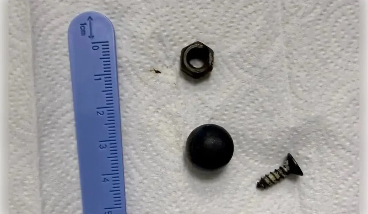 Шымкентте алты жасар бала бір магнит, болт пен бұранданы жұтып қойған