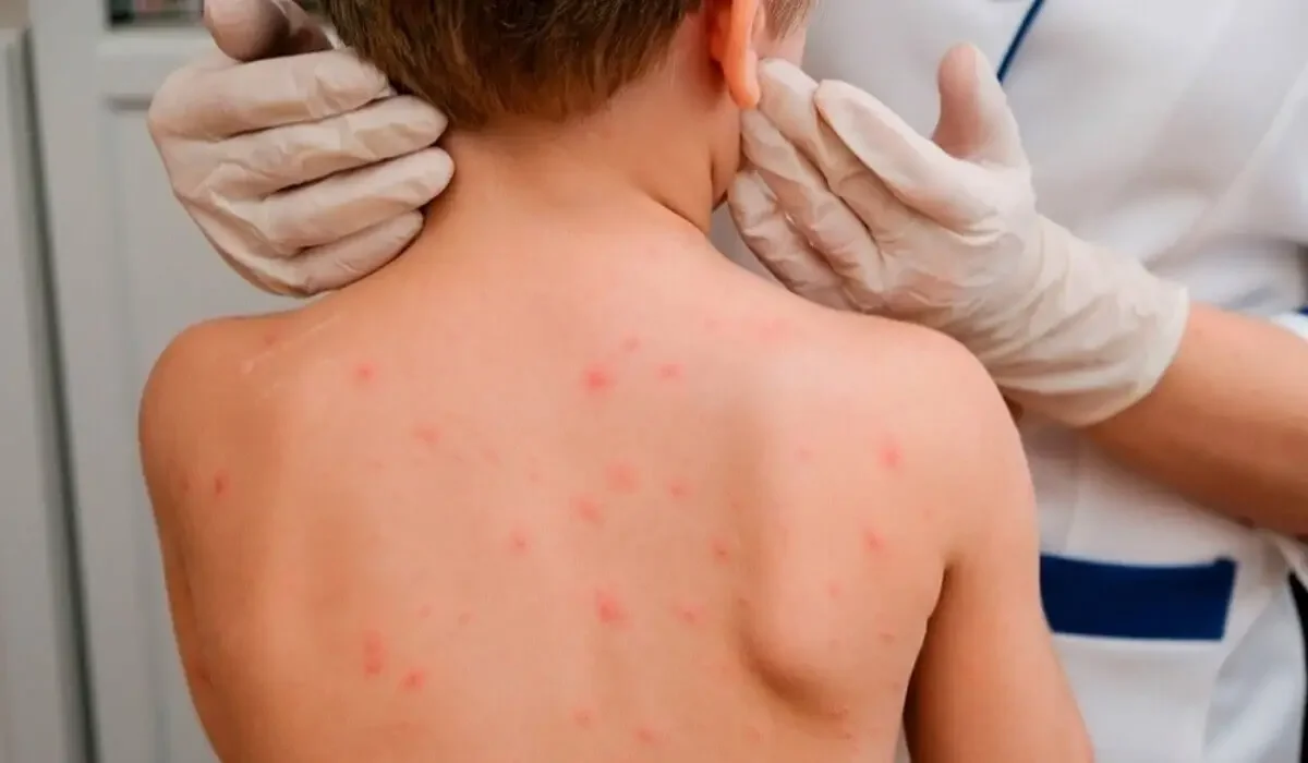 БҚО-да баладан қызылшаның өлімге әкелуі мүмкін қауіпті асқынуы анықталды