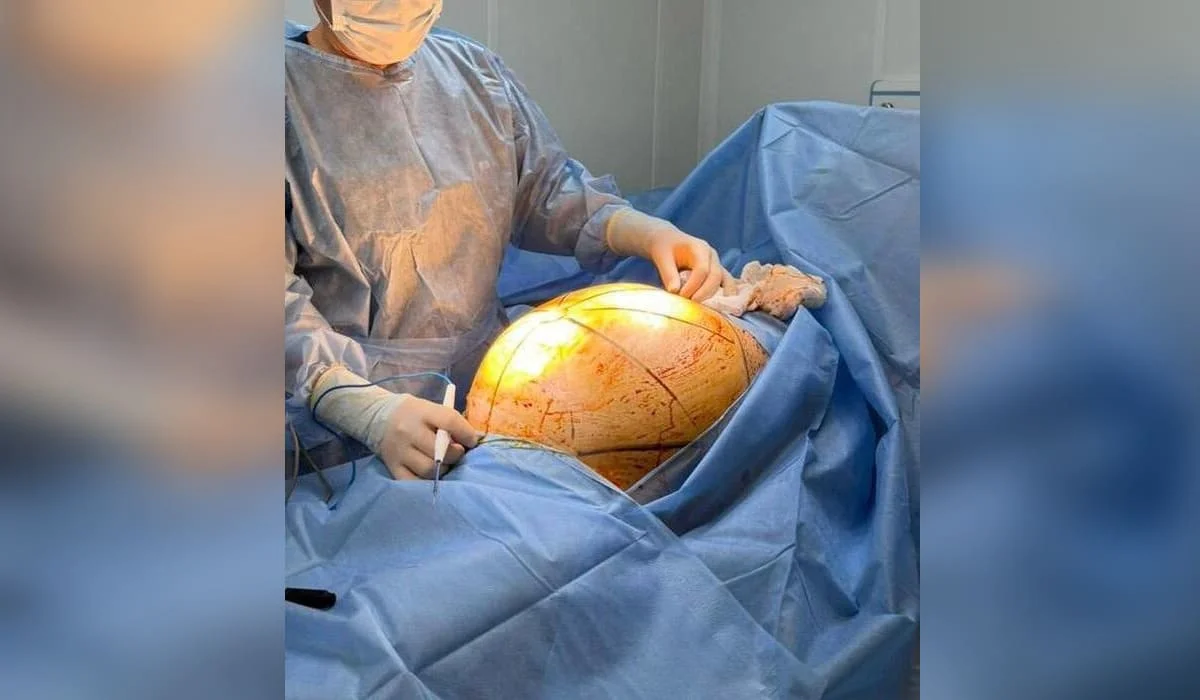 «Сыртынан қарағанда аяғы ауыр әйелге ұқсады»: Алматы дәрігерлері 69 жастағы әженің ішінен 25 келі ісік алып шыққан (ФОТО)