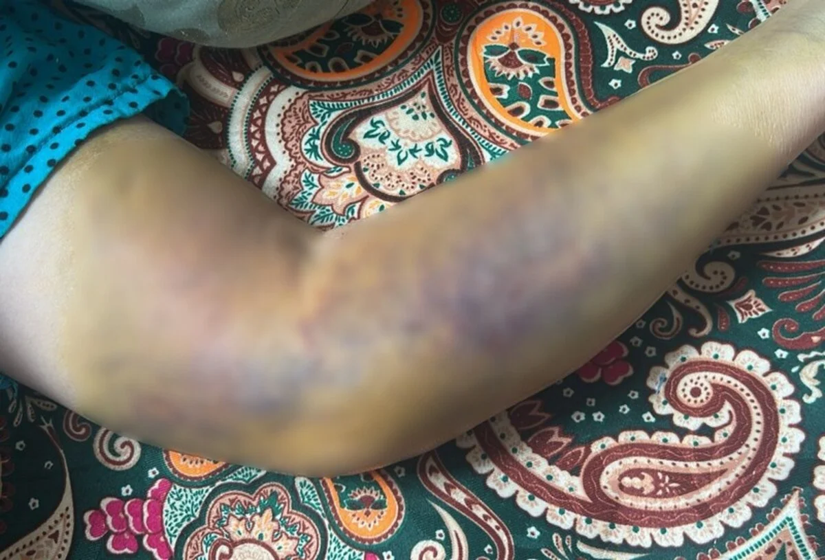 Ақтауда инъекциядан кейін әйелдің қолы істемей қалған