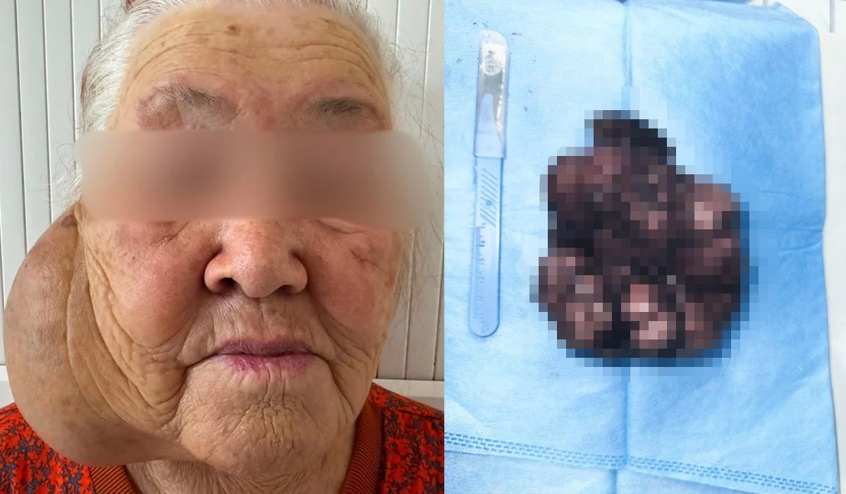 Адам басындай ісікпен 10 жыл өмір сүрген: Алматыда дәрігерлер әжейді құтқарып қалды