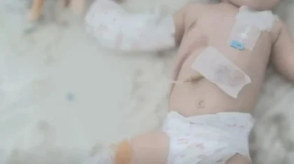 «Денесінің 30 пайызы күйіп қалған»: полиция 3 ай бұрын болған оқиғаға байланысты жауап берді