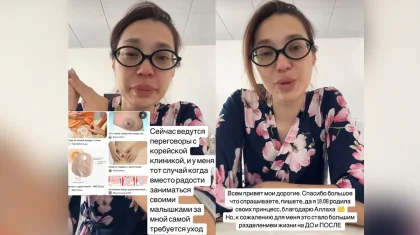 Ақтөбе дәрігерлері егіз қыз босанған келіншектің жатыры мен қуығын бірге тігіп жіберген