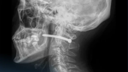 Петропавлда жөндеу жұмыстары кезінде ер адамның мойнына шеге қадалып қалды