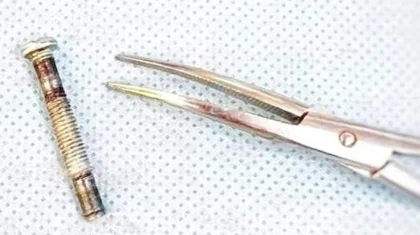 Түркістан облысында бір жасар сәби темір болт жұтып қойған