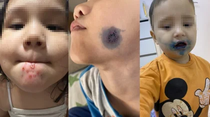 Ата-аналар алаңдаулы: балалардың беті мен денесіне біртүрлі жара шығып жатыр