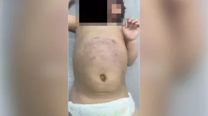 Жетісуда әкесі аяусыз ұрған үш жасар бүлдіршін хирургиялық бөлімде жатыр