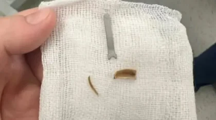 Ақтауда 11 айлық сәбидің өкпесінен металл табылды