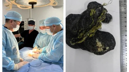 «Жеті күн бойы іші ауырған»: Шымкентте 8 жасар баланың асқазанына шаш ұйысып қалған