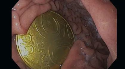 «Ата-анасы өзі түсіп қалады деп ойлаған»: Ақтауда бес жасар бала 50 теңгелік тиынды жұтып алып, үш күн жүрген (ФОТО)