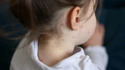 Қызылша жұқтырған әрбір адам орта есеппен 12-18 адамға ауру таратады – Астана дәрігерлері дабыл қақты