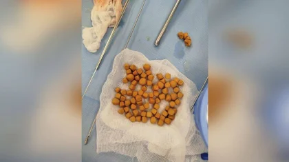 Түркістанда 61 жастағы тұрғынның қуығынан 80 тас шыққан (ФОТО)