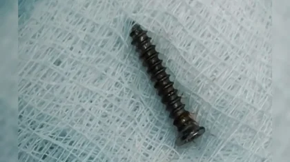 Павлодарда дәрігерлер кішкентай баланың асқазанынан бұранда алып шықты