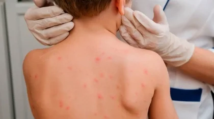 БҚО-да баладан қызылшаның өлімге әкелуі мүмкін қауіпті асқынуы анықталды