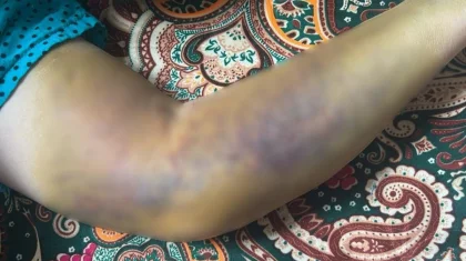 Ақтауда инъекциядан кейін әйелдің қолы істемей қалған