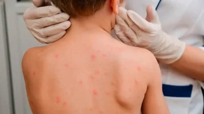 Қазақстанда қызылша жұқтырған балалардың саны азайып келеді