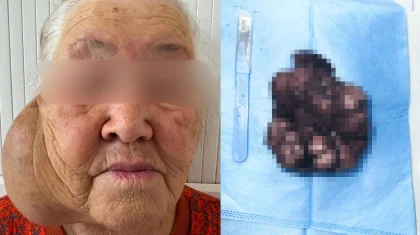 Адам басындай ісікпен 10 жыл өмір сүрген: Алматыда дәрігерлер әжейді құтқарып қалды