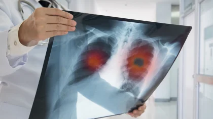 Өкпе обырын анықтайтын отандық AI жүйесі іске қосылмай тұр: депутат Бектеновке шүйлікті
